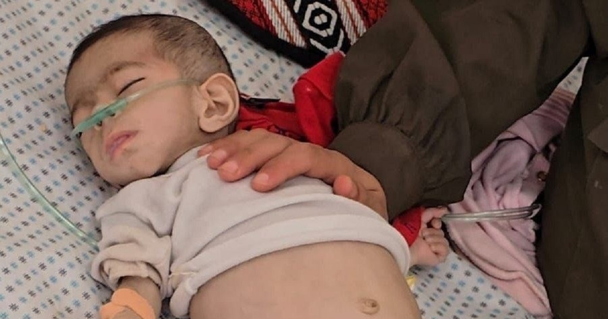 6 وفيات نتيجة المجاعة وسوء التغذية في غزة