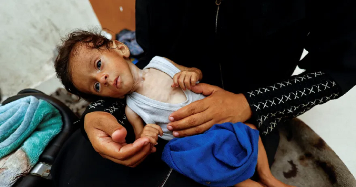 ارتفاع إجمالي وفيات سوء التغذية إلى 370 شهيدا