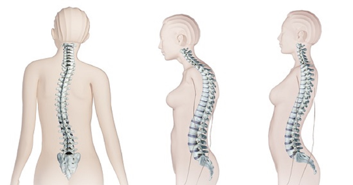 الجنف.. انحناء العمود الفقري بين عوامل وراثية وأمل العلاج المبكر