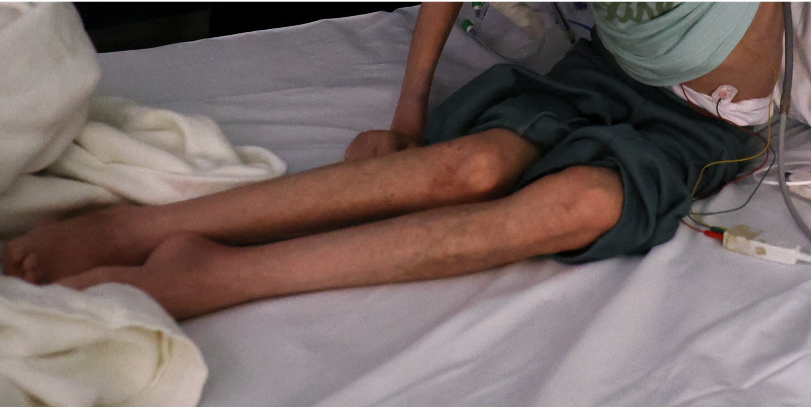 3 وفيات بمتلازمة "غيلان باريه" وتحذيرات من تفشي الشلل الرخو الحاد بغزة