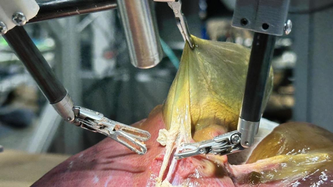 روبوت أميركي ينجز أوّل عملية جراحية لاستئصال مرارة بلا تدخّل بشري