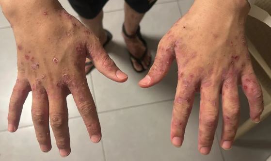 نادي الأسير: تسجيل إصابات بمرض الجرب (السكابيوس) بين صفوف الأسيرات في سجن (الدامون